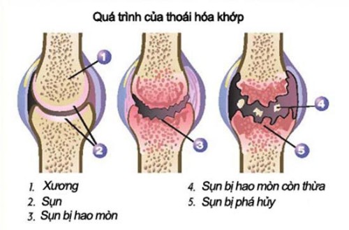 Thoái hóa xương khớp là tình trạng hư hỏng phần sụn, khiến hai đầu xương không được bảo vệ và thường xuyên cọ xát vào nhau gây đau. Nhận biết triệu chứng thoái hóa xương khớp sớm có thể giúp người bệnh điều trị bệnh kịp thời, nhằm tránh những hậu quả và biến chứng nặng nề. bệnh xương khớp là gì