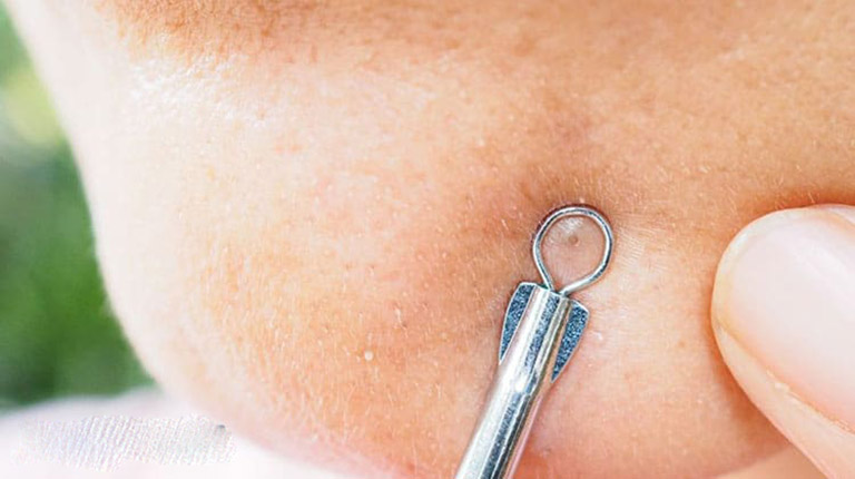 cách trị mụn nhanh nhất ở tuổi dậy thì cách trị mụn nhanh nhất ở tuổi dậy thì